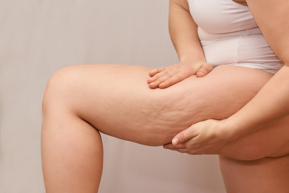 Was ist Cellulite?